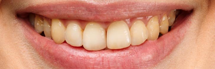 Before smile treatment